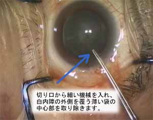 cataract_01