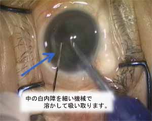 cataract_02
