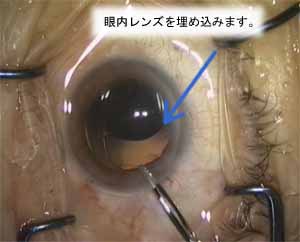 cataract_03
