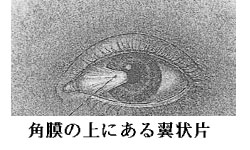 角膜の上にある翼状片 角膜の上にある翼状片