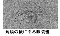 角膜の横にある瞼裂斑 角膜の横にある瞼裂斑