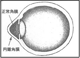円錐角膜