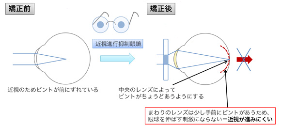 眼鏡による矯正法