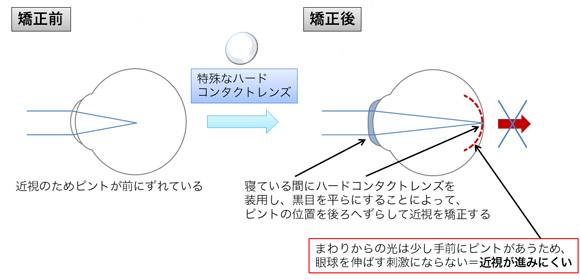 オルソケラトロジーレンズによる矯正法